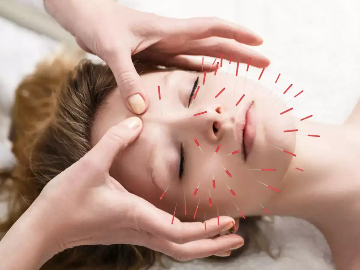 Medical acupuncture for motor vehicle accident recovery